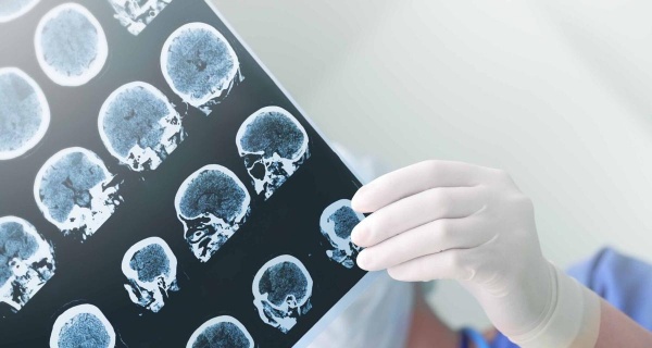 Most Hospitalized COVID Patients Have Neurological Symptoms Study Says