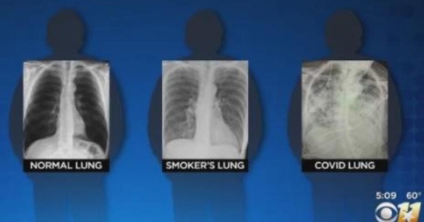 Post COVID Lungs Worse Than The worst Smokers Lungs Surgeon Says